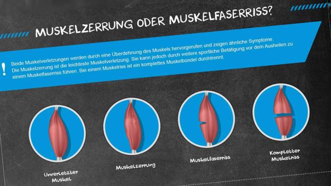 Was Hilft Gegen Zerrung Im Oberschenkel zerrungen.behandeln.de